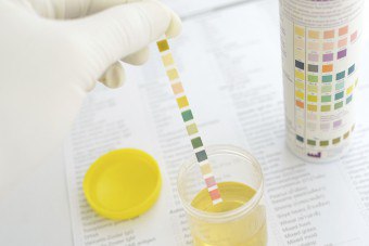 明るい黄色の尿：現象の主な原因。尿の色の変化は何ですか？