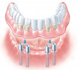 وجع الأسنان بعد الأطراف الاصطناعية - ماذا تفعل؟